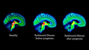 Advanced Neuro Imaging with PET of the Brain