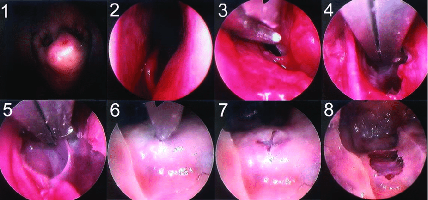 PITUITARY TUMORS