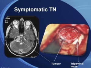 symptomatic-TN