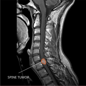 Ependymoma MRI Spin tumor