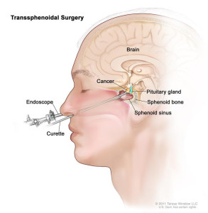 Transsphenoidal surgery. An endoscope and a curette are inserted through the nose and sphenoid sinus to remove cancer from the pituitary gland.