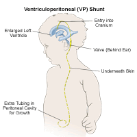 Ventriculoperitoneal-shunt