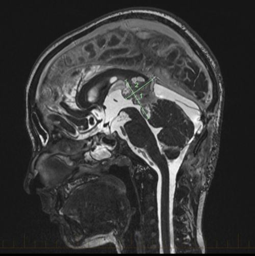 pineoblastoma