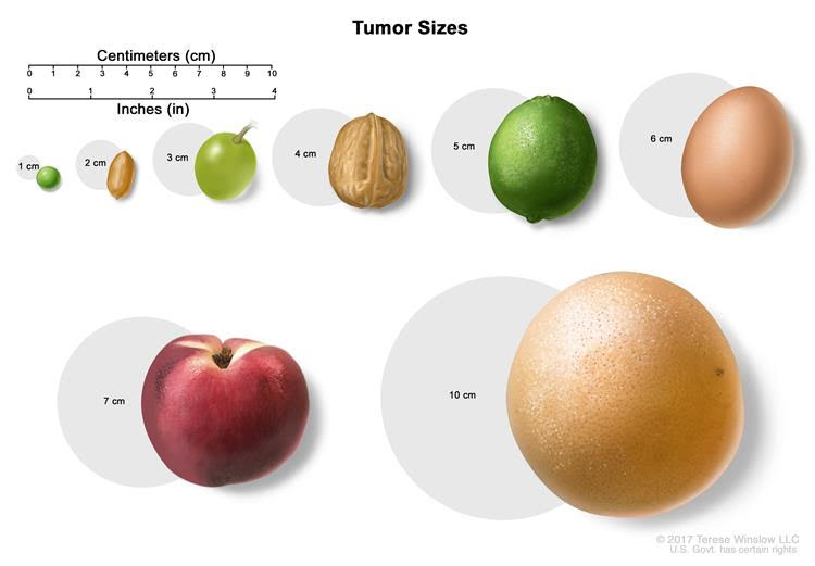 tumor-sizes