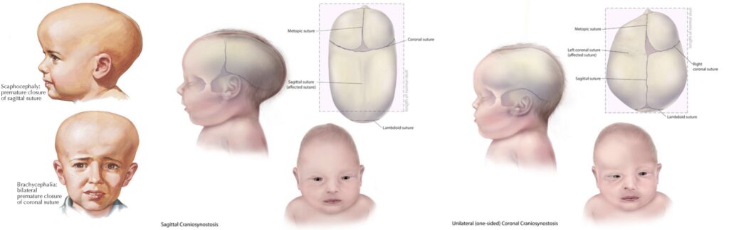 Craniosynostosis Dr Prem Pillay Craniosynostosis Dr Prem Pillay